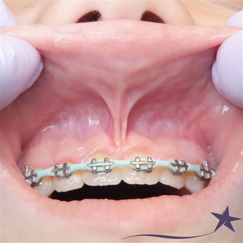 lip tie westerville  dentist northstar family dental