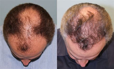 hair growth  hair transplant fbryu