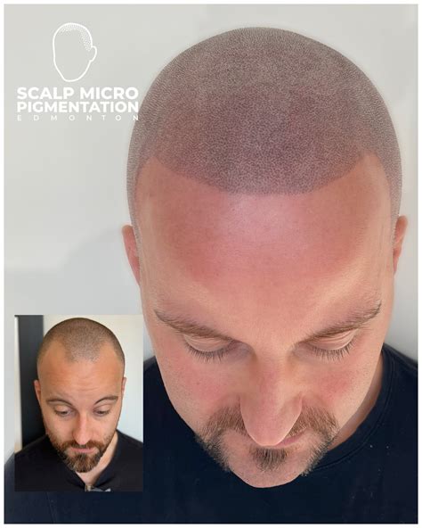 Before and After SMP Scalp micropigmentation