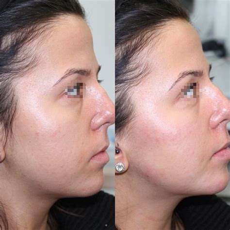 Almas’s transformation with Jaw & Cheek filler
