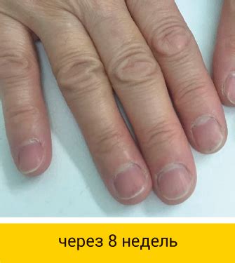 Миколепт® лак от грибка ногтей. Официальный сайт