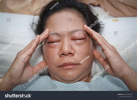 swollen head images stock  vectors shutterstock