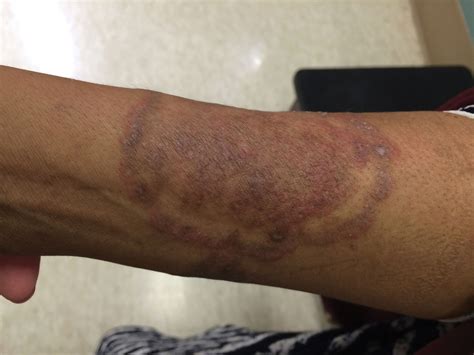 3-week-old presents with rapidly spreading erythematous annular lesions