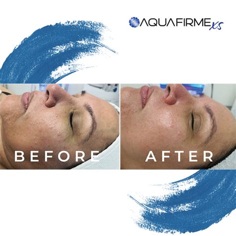 Aquafirme XS Facial Treatment | Life Spann, Gilbert AZ