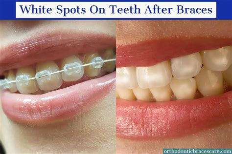 Teeth Treat: How to get rid of white stains on teeth after braces