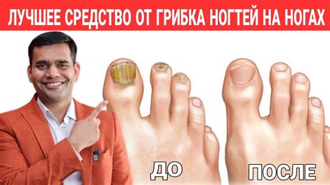 Лучшее Средство От Грибка Ногтей На Ногах | Доктор Вивек - YouTube
