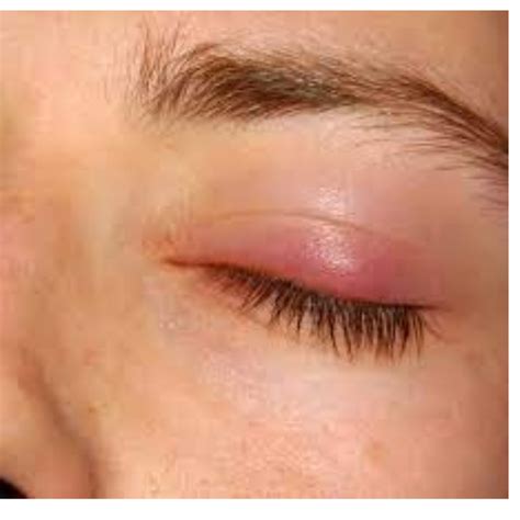 Chalazion Treatment at Rs 2500 in Noida | ID: 26085584130