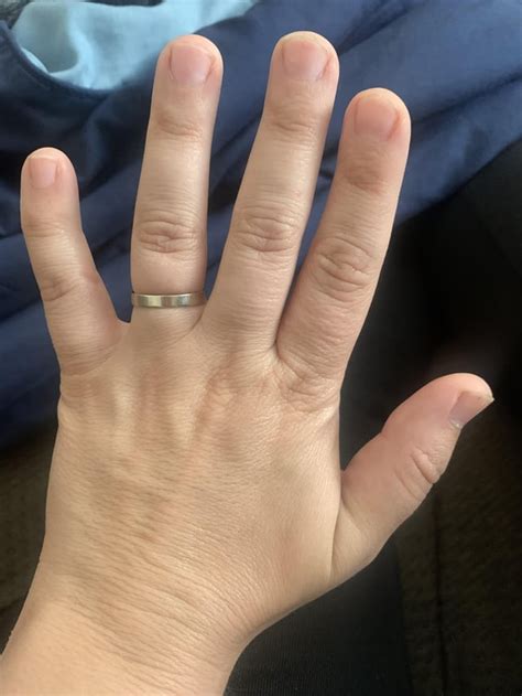 Acrogeria? I’m a 32 year old female. Do my hands look “older “? I go to ...