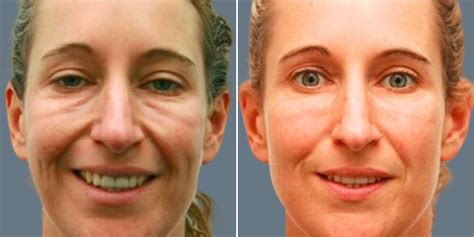 Cheek Fillers & Costs | Sydney, Gold Coast, Canberra & Adelaide
