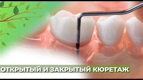 Открытый и закрытый кюретаж☘️ - YouTube