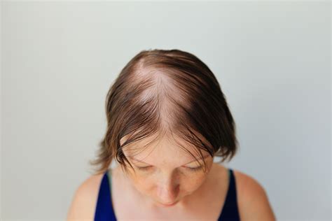 uptitration  baricitinib effective  improving hair growth