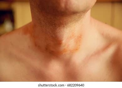 Allergic Skin Rash Spots On Neck Foto Stok 682209619 | Shutterstock