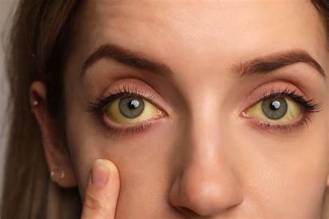 Can Drinking Alcohol Cause Yellow Eyes? | Zinnia Health