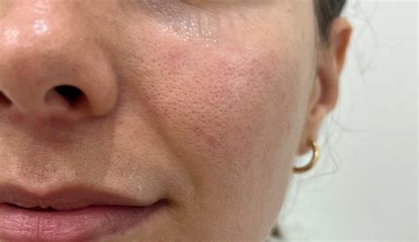 Large Pores Treatment Adelaide- Advanced Cosmetic Medicine