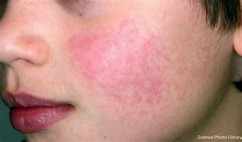 Slapped Cheek Syndrome: what the rash looks like | MadeForMums