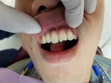 a simple aesthetic restoration... no... - Riverside Dental