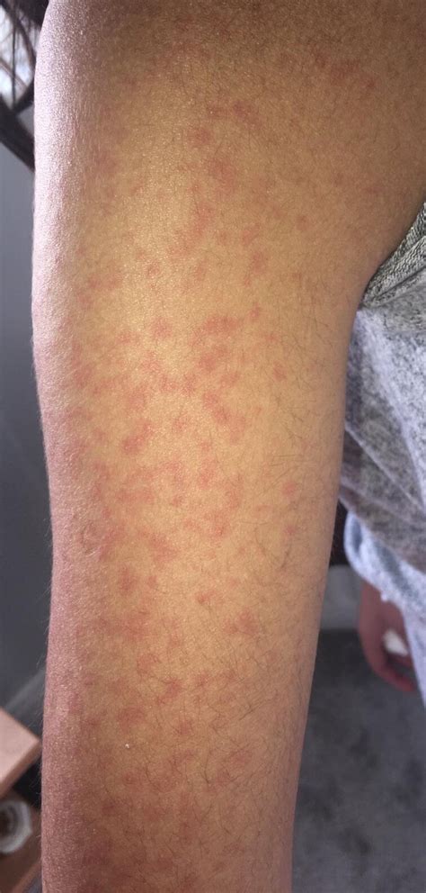 Viral Rash Pictures of Viral Rashes in Adults & Children