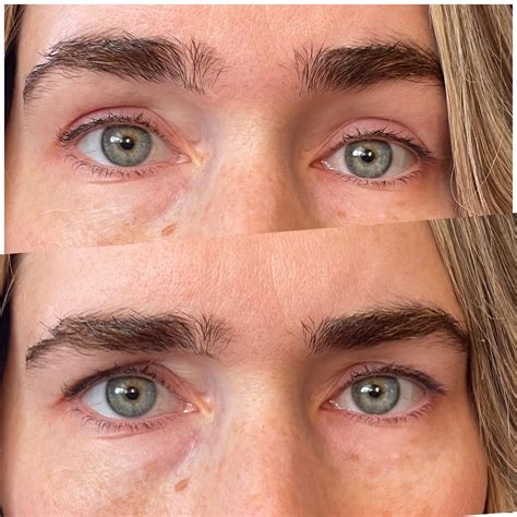 upperlower bleph  brow lift rplasticsurgery