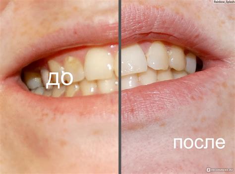 Карандаш для отбеливания зубов My Brilliant Smile Косметическое ...
