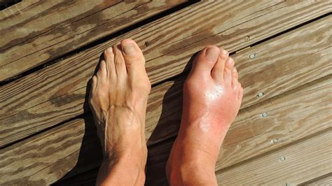 Quels sont les symptômes de la goutte? - Le conseil santé