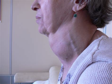 Нетоксический зоб, причины, симптомы, лечение | MedKontrol Мариуполь