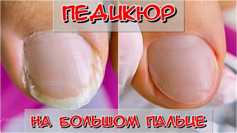 Педикюр на большой палец / Комбинированный педикюр / Средства для ...