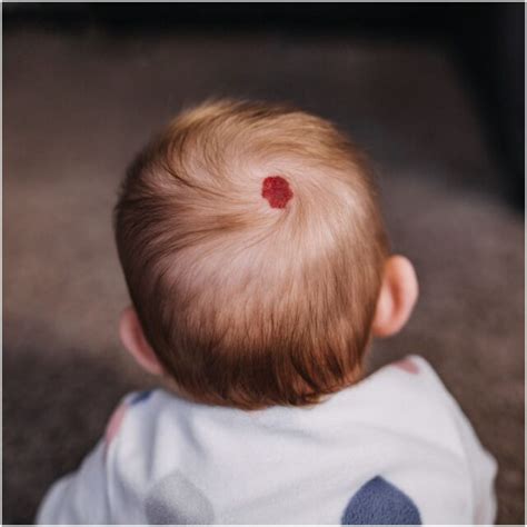 Birthmarks - Spiritual Meanings & Superstitions - Insight state