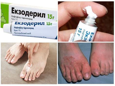 Мазь от грибка кожи - список самых эффективных для лечения различных ...