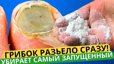 ГРИБКОВЫЙ НОГОТЬ СЛЕЗ, А НОВЫЙ Вырос! МОЩНЕЙШИЙ РЕЦЕПТ: ГРИБОК Ногтей ...