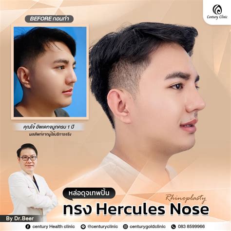 รีวิว แก้จมูก #771 - Century Health Clinic