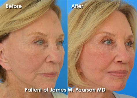 Dermabrasion Photos - Before & After - Dr. James Pearson Facial Plastic ...