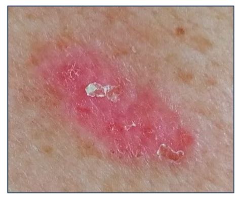 Basal Cell Carcinoma Dermoscopy at Oliver Vaccari blog