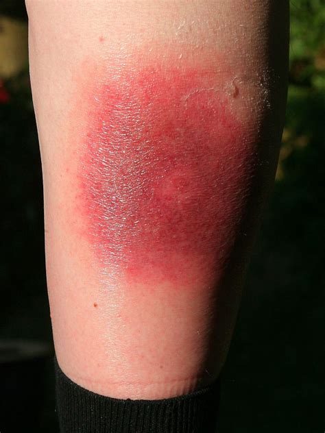 Gefahr durch Zeckenbiss: Was man über Lyme-Borreliose wissen sollte - n ...