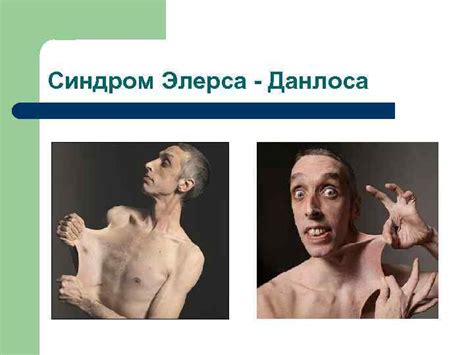 НАСЛЕДСТВЕННЫЕ НАРУШЕНИЯ РАЗВИТИЯ ТКАНЕЙ ЗУБОВ Изменения дентина сочетанные