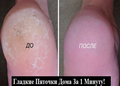 СУПЕР-СРЕДСТВО ДЛЯ ВАШИХ ПЯТОЧЕК. ПОМОГАЕТ ЗА МИНУТУ | Женские заметки