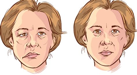 How Bell’s Palsy Affects the Eyes | Ophthalmologist in Rapid City, SD ...