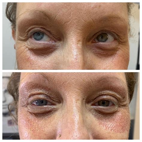 plasma fibroblast  eye treatment reliable supplier www