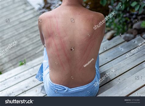 Dermatographic Urticaria Known Dermographism Dermatographism Skin Stock ...