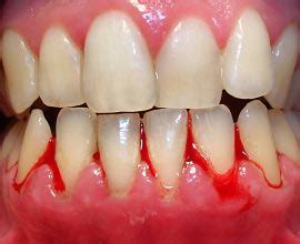 Пародонтит: Етиология, Класификация, Лечение • IG Dental