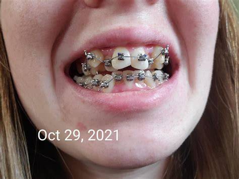 i just got my braces on today and i feel ugly :( i was never insecure