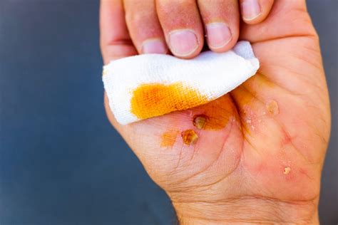 How to Clean a Small Wound: Essential First Aid Advice