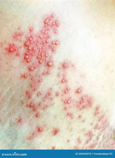 A Close Up View of Women with Shingles (herpes Zoster) Disease on Skin