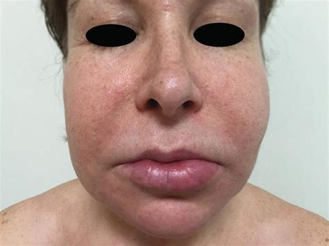 Periorbital Edema Hypothyroidism