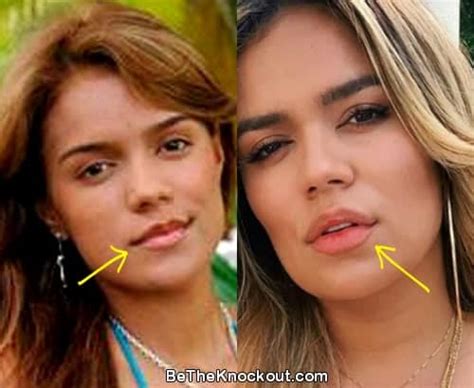 Karol G Plastic Surgery Comparison Photos