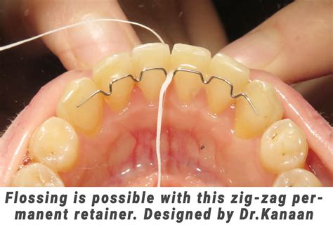 Permanent Retainers in Sugar Land, TX | iSmile Specialists