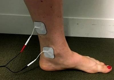 post tibial nerve stimulation coding alis
