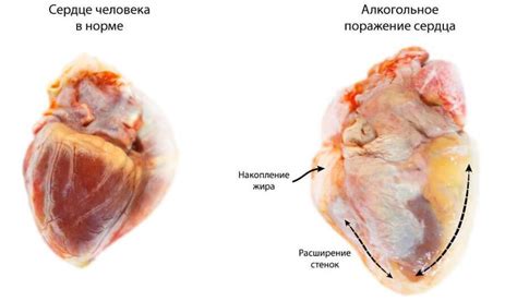 Alcoholic cardiomyopathy