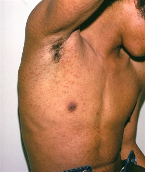 Pityriasis Lichenoides - Dermatologic Disorders - MSD Manual