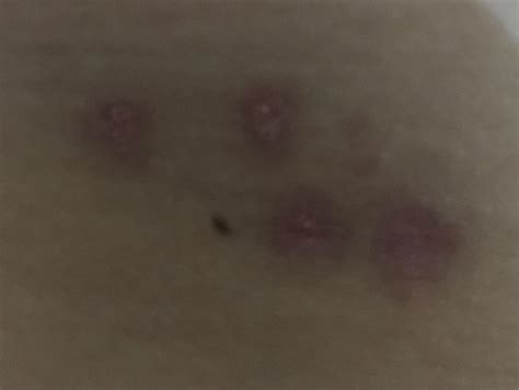 burns on my upper thigh : r/SelfHarmScars