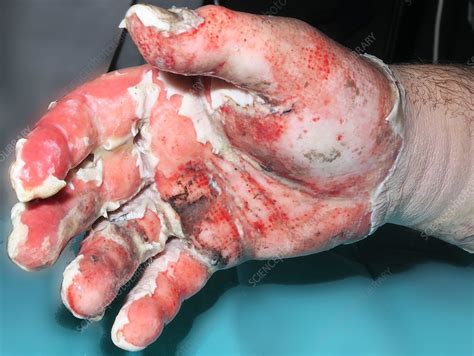 degree burn stock image  science photo library